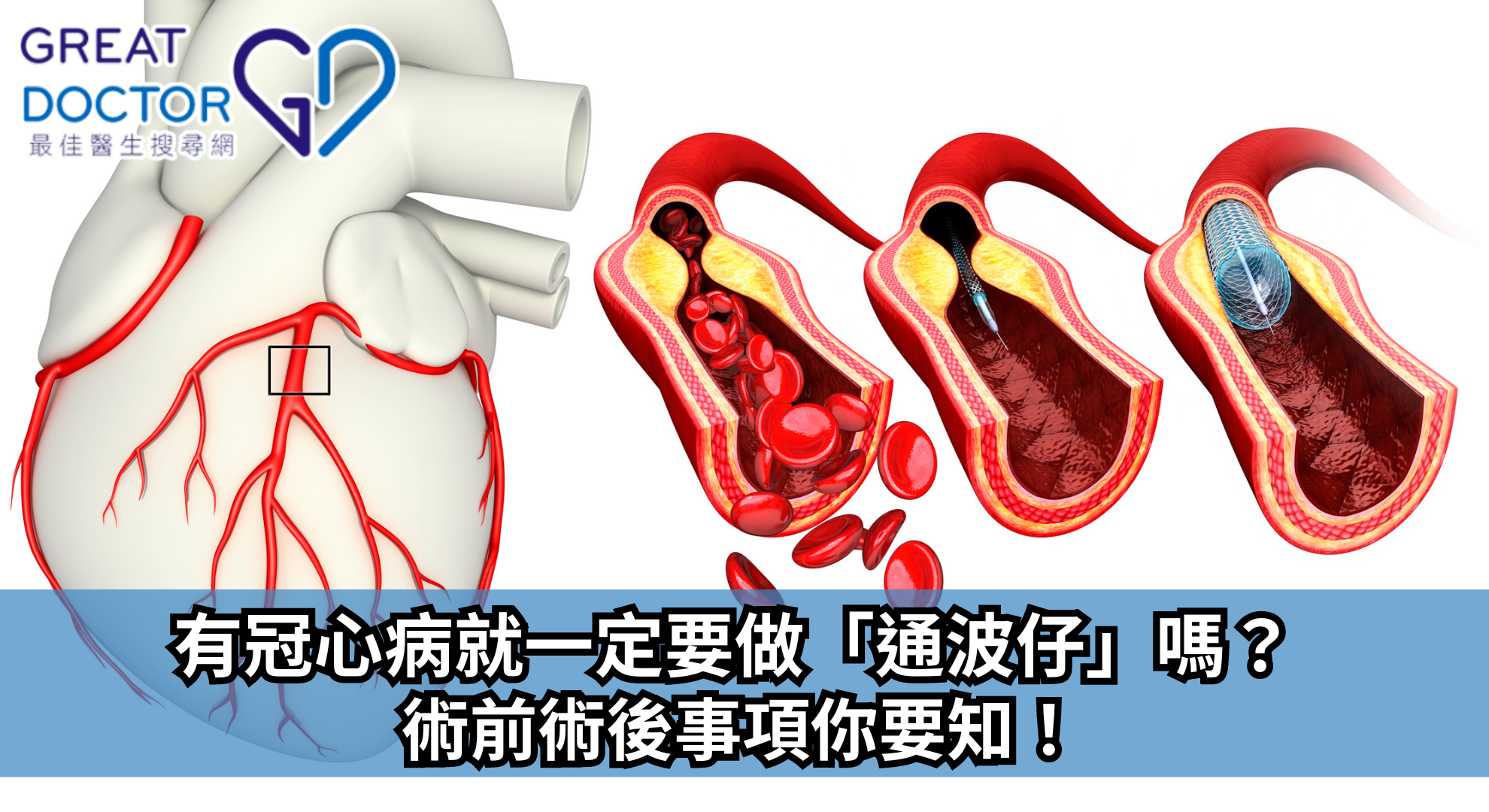 有冠心病就一定要做「通波仔」嗎？ 術前術後事項你要知！