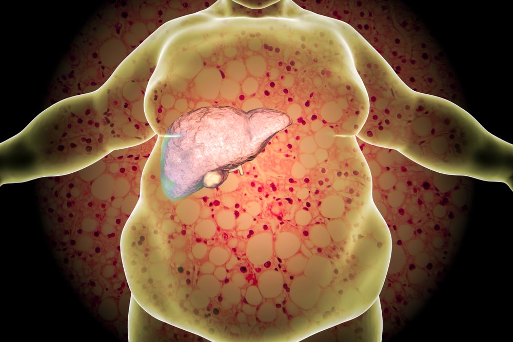 四分一港人患脂肪肝　忽視隨時變肝癌